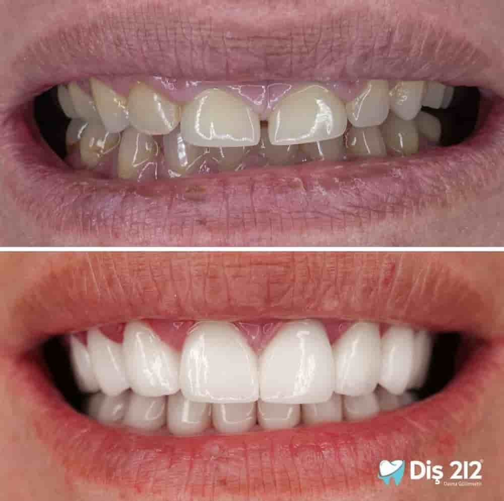 Verifizierte Patientenbewertungen von Dis 212 - Dental Aesthetics Facility in Istanbul, Turkey Slider image 5