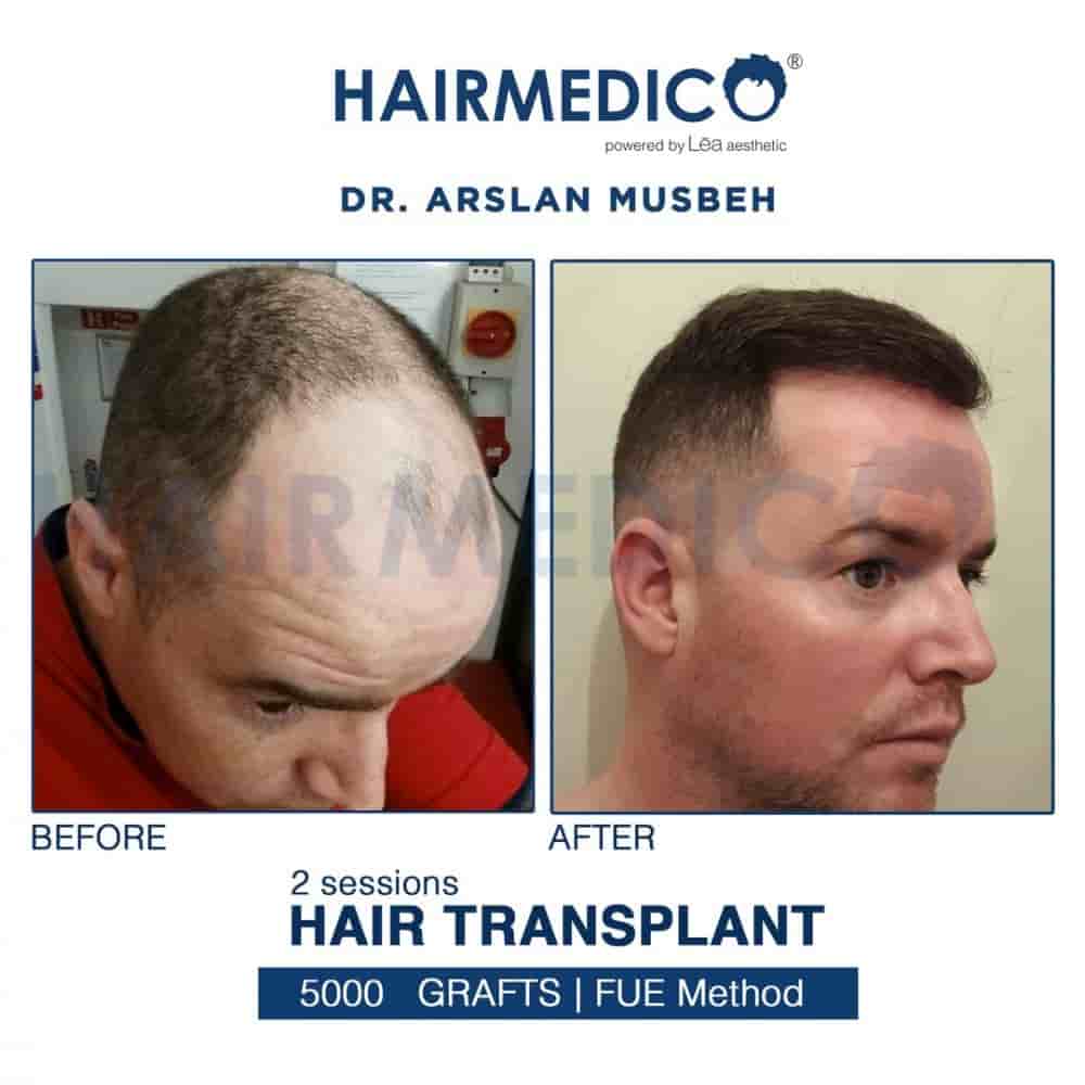 Verifizierte Patientenbewertungen von Hairmedico in Istanbul, Turkey Slider image 3