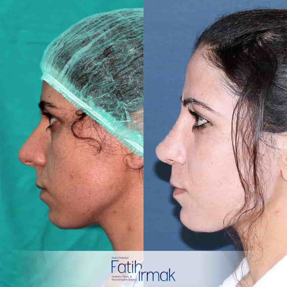 Verifizierte Patientenbewertungen von Assoc. Prof. Fatih Irmak Aesthetic and Plastic Surgery Clinic in Istanbul, Turkey Slider image 1