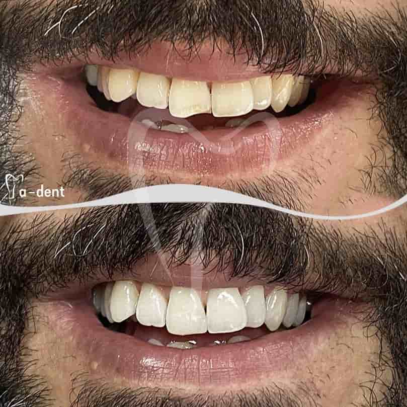 Verifizierte Patientenbewertungen von A-dent Dental Clinic in Antalya, Turkey Slider image 2