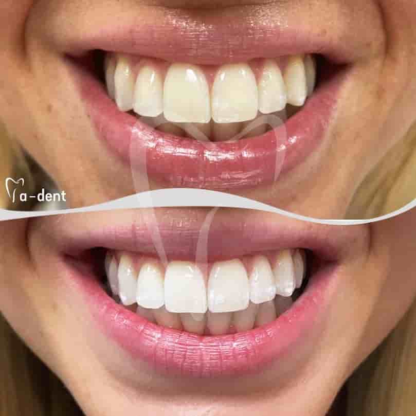 Verifizierte Patientenbewertungen von A-dent Dental Clinic in Antalya, Turkey Slider image 4