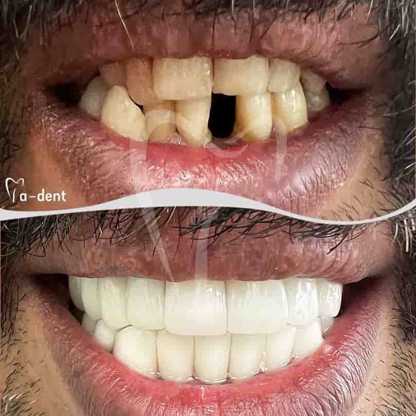 Verifizierte Patientenbewertungen von A-dent Dental Clinic in Antalya, Turkey Slider image 7