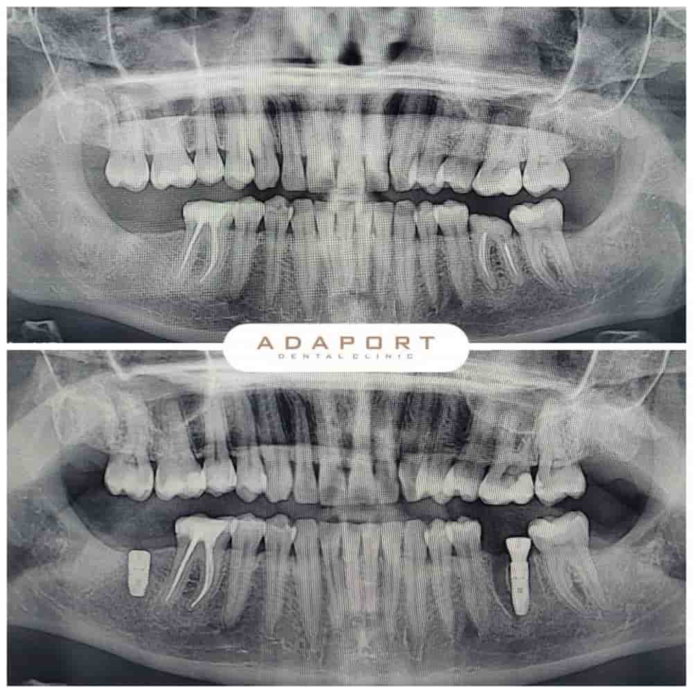 Verifizierte Patientenbewertungen von Adaport Dental Clinic in Izmir, Turkey Slider image 2