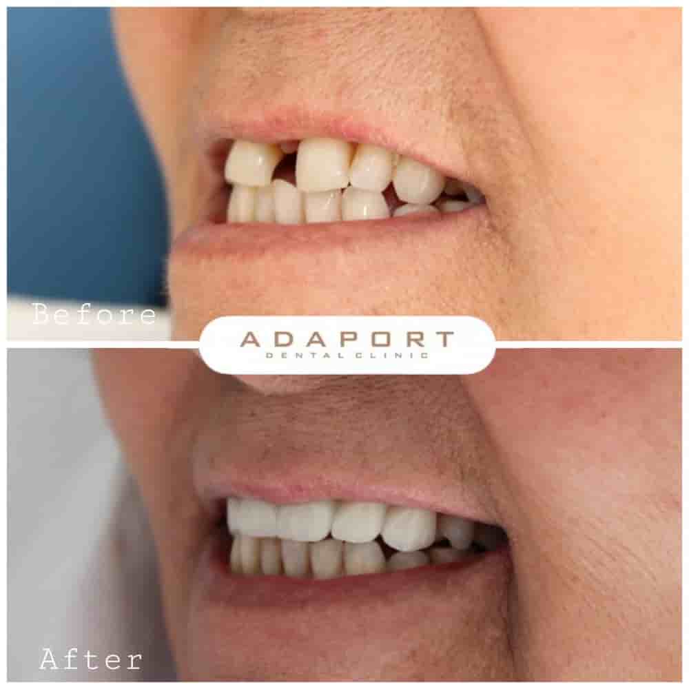 Verifizierte Patientenbewertungen von Adaport Dental Clinic in Izmir, Turkey Slider image 3