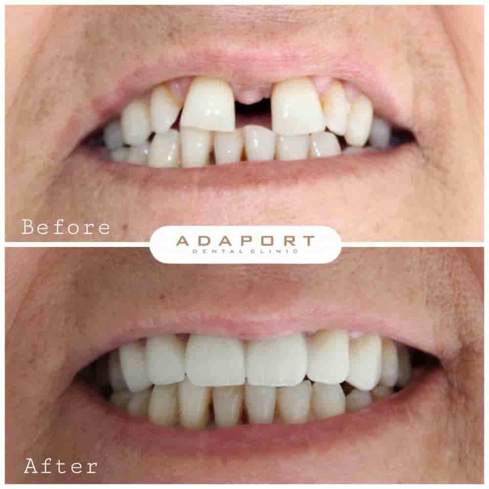 Verifizierte Patientenbewertungen von Adaport Dental Clinic in Izmir, Turkey Slider image 4