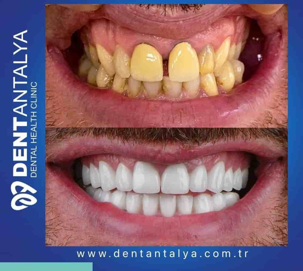 Verifizierte Patientenbewertungen von Dent Antalya in Antalya, Turkey Slider image 9