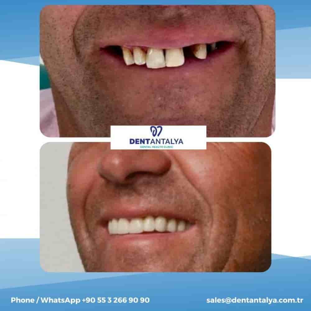 Verifizierte Patientenbewertungen von Dent Antalya in Antalya, Turkey Slider image 2
