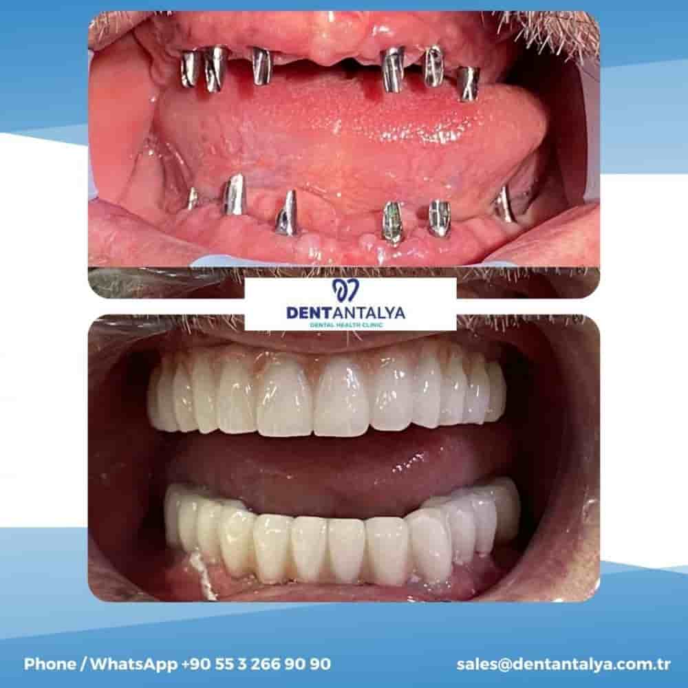 Verifizierte Patientenbewertungen von Dent Antalya in Antalya, Turkey Slider image 7