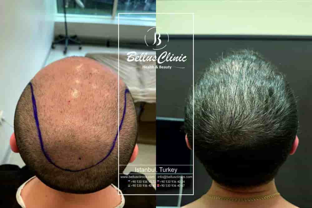 Verifizierte Patientenbewertungen von Bellus Clinic in Istanbul, Turkey Slider image 7