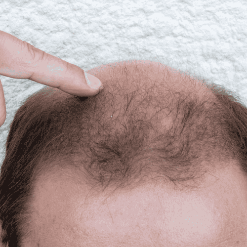 Plättchenreiches Plasma für Haartransplantationen in Mexiko-Stadt, Mexiko