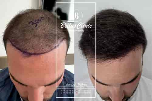 DHI-Haartransplantationspaket der Bellus Clinic