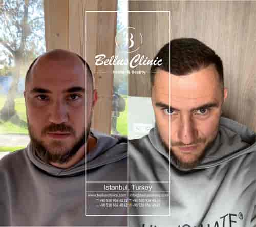 FUE-Haartransplantation in der Bellus Clinic – holen Sie sich Ihr Haar zurück mit der Bellus Clinic