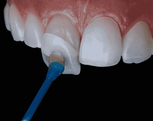 E-Max Laminate Veneers Paket in der Clinic Prime Istanbul, Türkei