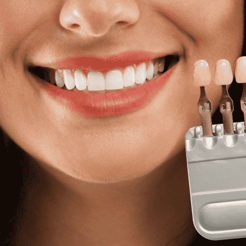 Smile Makeover in Istanbul – Hollywood-Lächeln, Implantate, Kronen in Istanbul