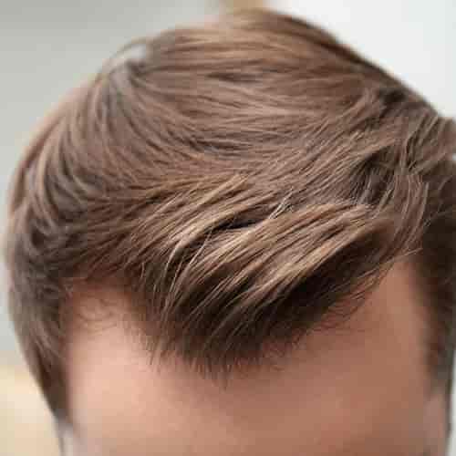 FUE-Haartransplantation in der Bellus Clinic – holen Sie sich Ihr Haar zurück mit der Bellus Clinic
