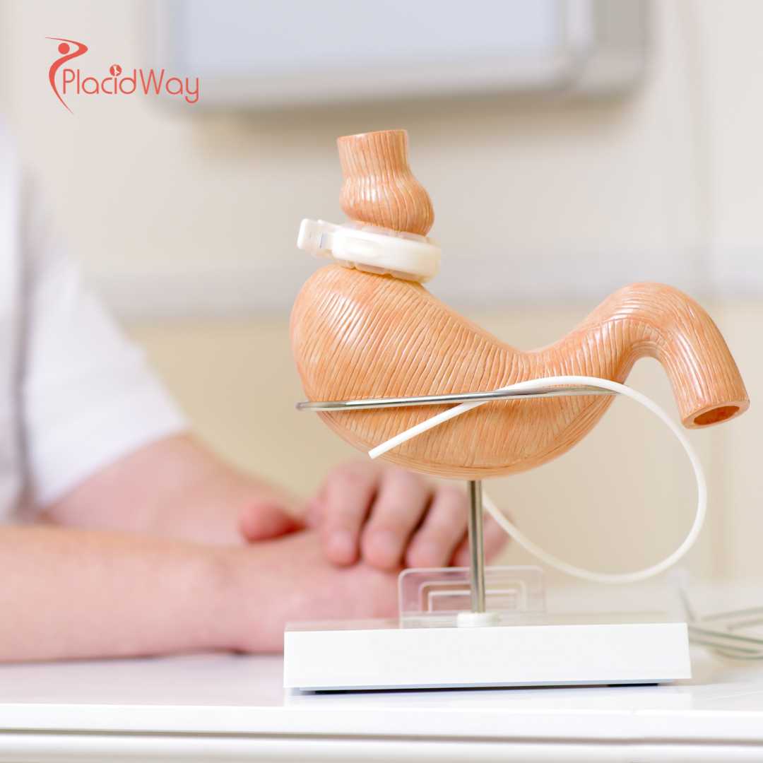 Revisionsoperationen nach bariatrischen Eingriffen in der Türkei für Patienten, die ihren Gewichtsverlust fortsetzen möchten