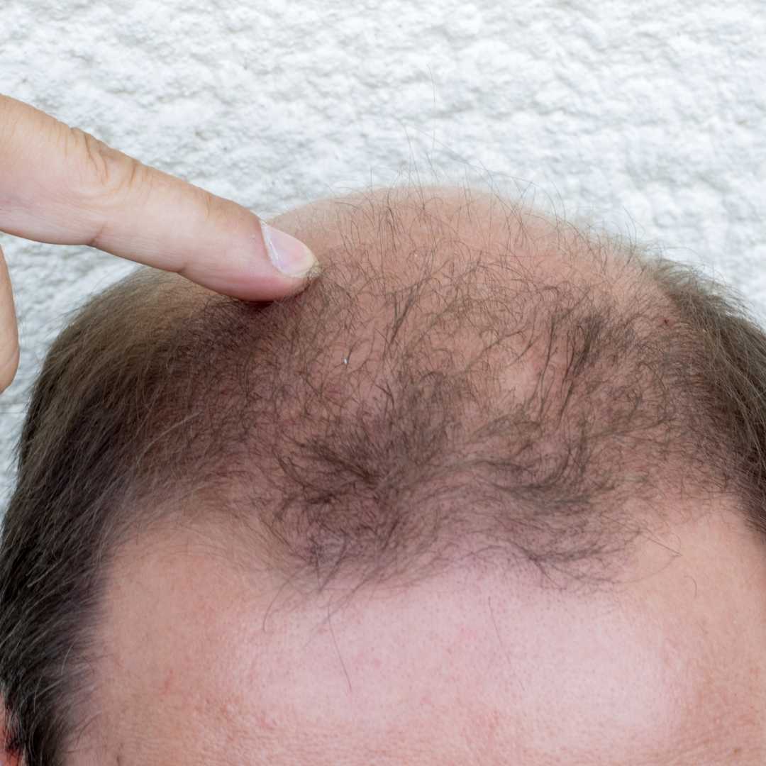 Plättchenreiches Plasma für Haartransplantationen in Mexiko-Stadt, Mexiko