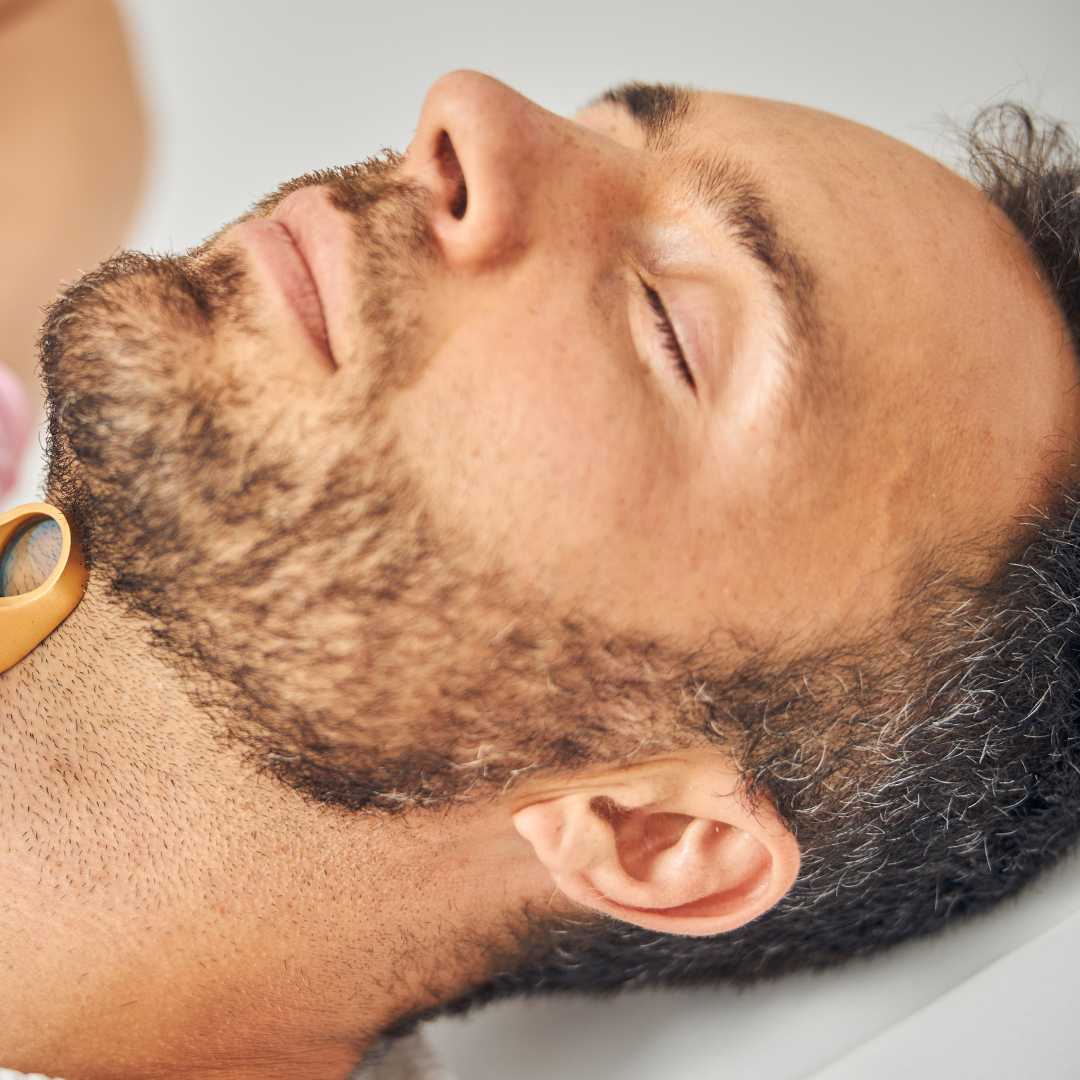 Barttransplantationspaket – Bis zu 500 Grafts
