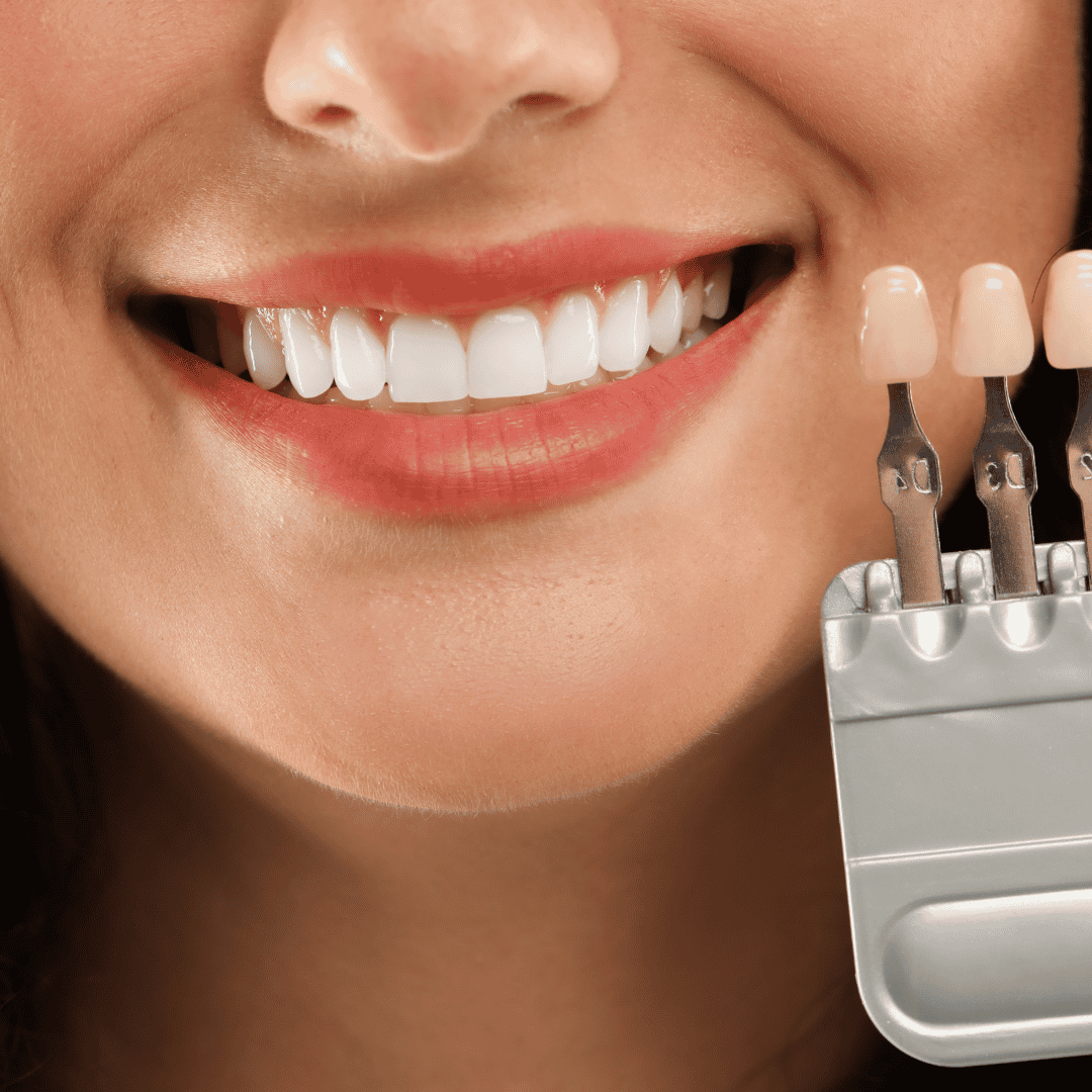 Smile Makeover in Istanbul – Hollywood-Lächeln, Implantate, Kronen in Istanbul