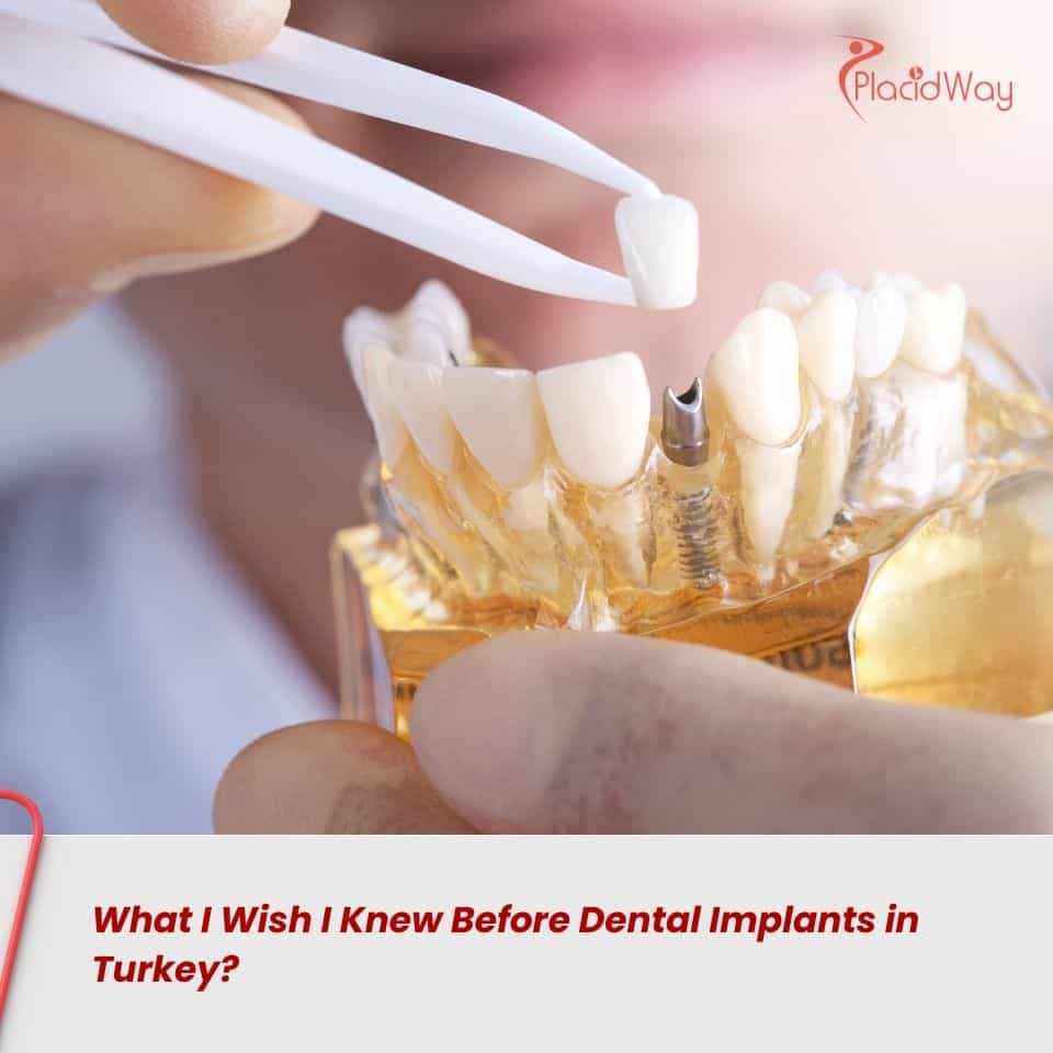 Was ich vor Zahnimplantaten in der Türkei gerne gewusst hätte?