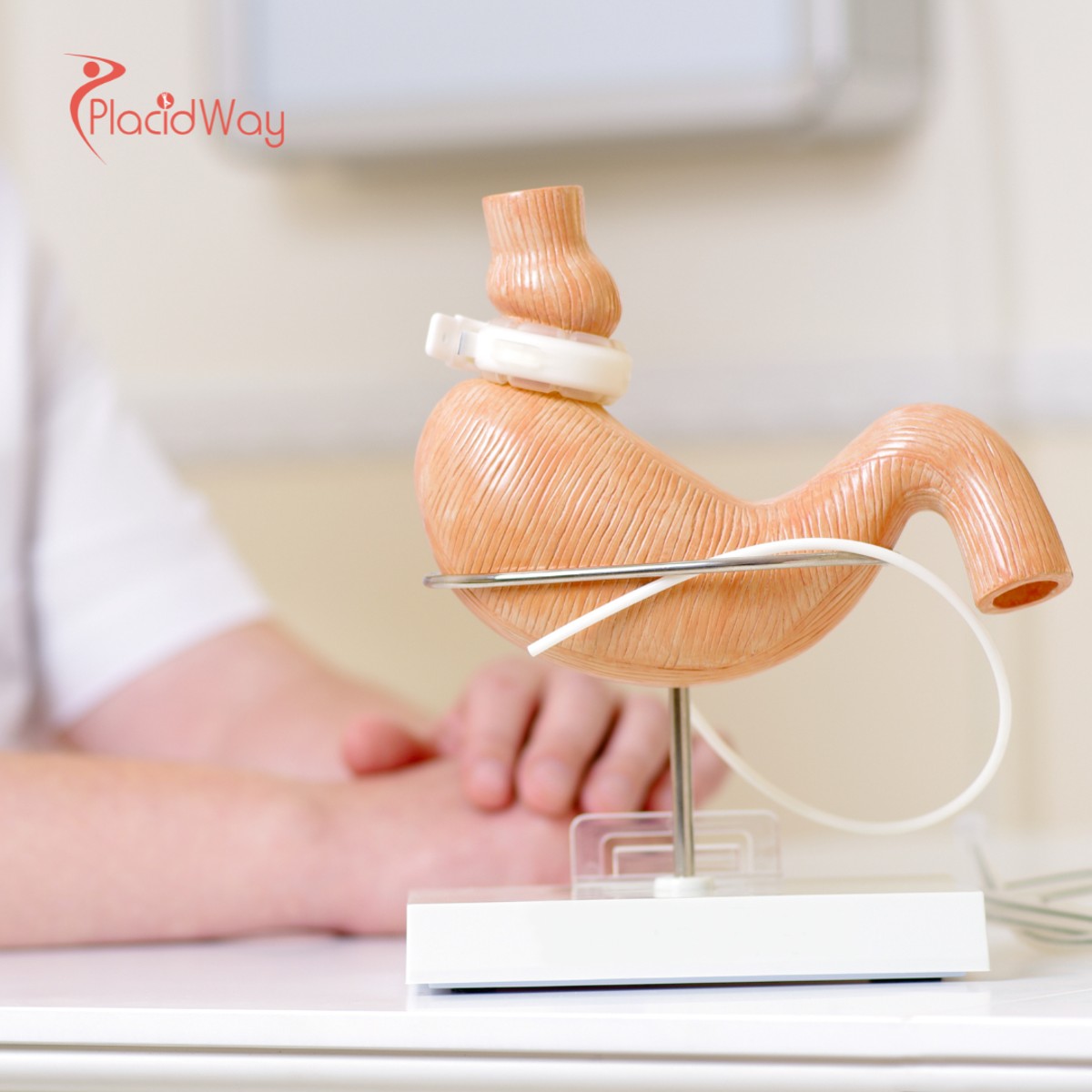 Revisionsoperationen nach bariatrischen Eingriffen in der Türkei für Patienten, die ihren Gewichtsverlust fortsetzen möchten