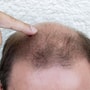 Plättchenreiches Plasma für Haartransplantationen in Mexiko-Stadt, Mexiko thumbnail